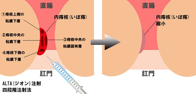 治療 いぼ 法 痔